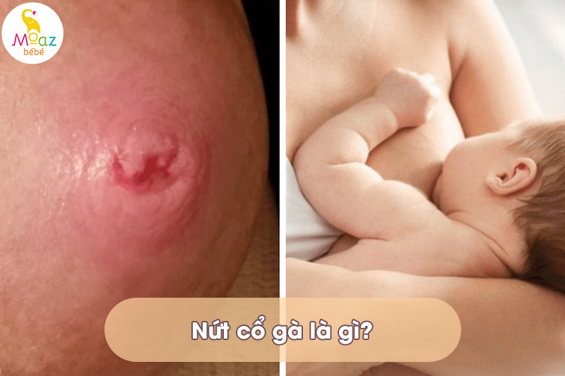 Nứt cổ gà là gì?